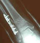 broken-leg-39days-post-break-2.jpg (60887 bytes)